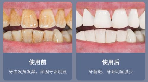 告別刷牙盲區(qū)，現(xiàn)代口腔護(hù)理新選擇 為何它能解決你的深層困擾